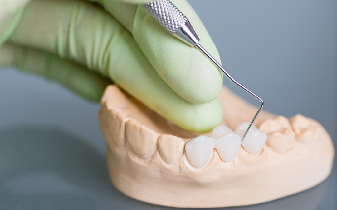 What Is The Point of a Dental Bridge?