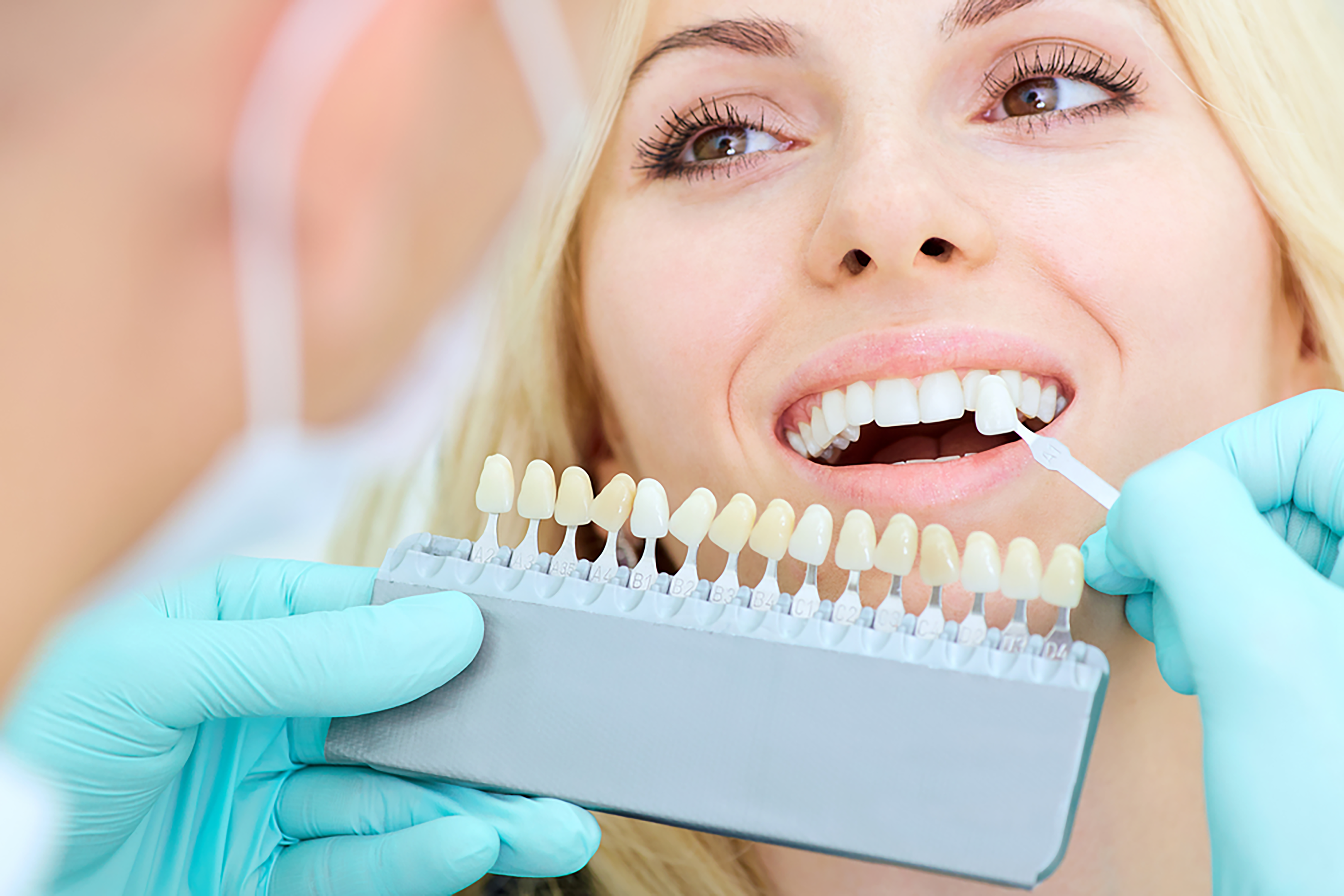 Dental Veneers ten facts to know