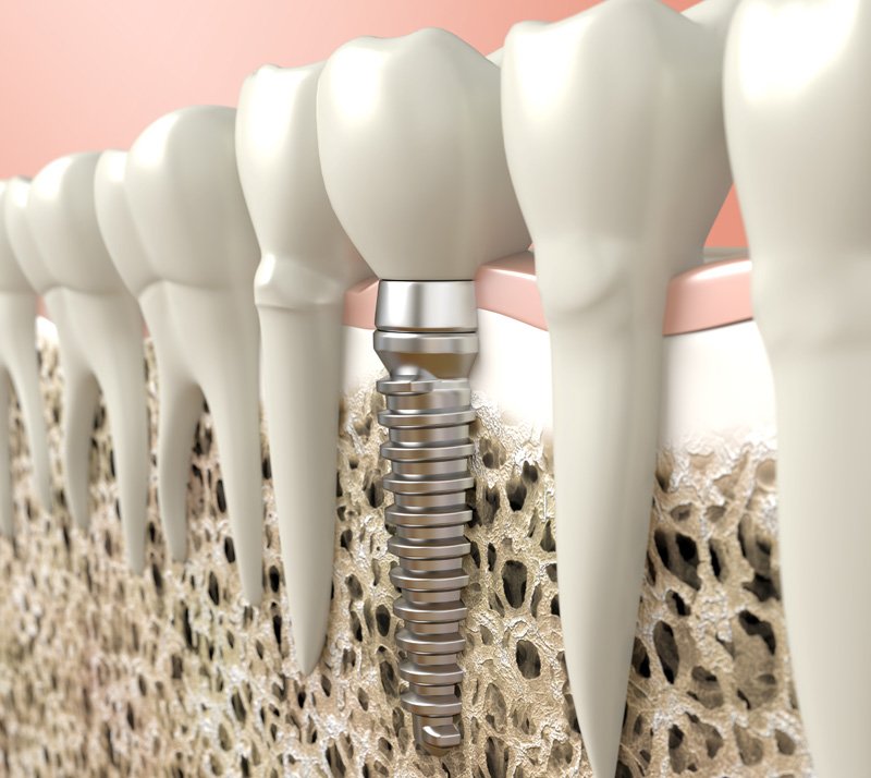 dental Implants in winnipeg