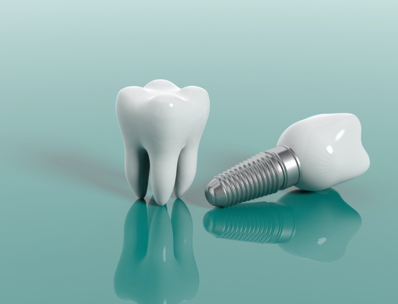 understanding dental implants by your winnipeg dentists